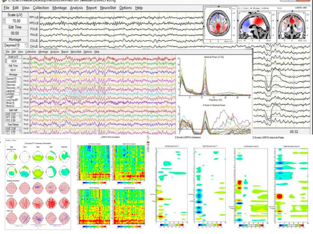 QEEG und LORETA Analysen